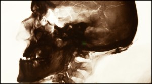 Detail of a 1917 X-ray of Charles's skull. The photograph shows no traces of any fragments of the projectile that killed him.