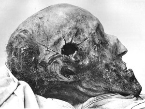 The right side of Charles XII's skull, showing what appears to be a significantly smaller entrance wound.