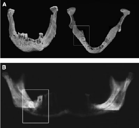 Serbian fractures.png